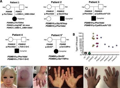 Identification of eight novel proteasome variants in five unrelated cases of proteasome-associated autoinflammatory syndromes (PRAAS)